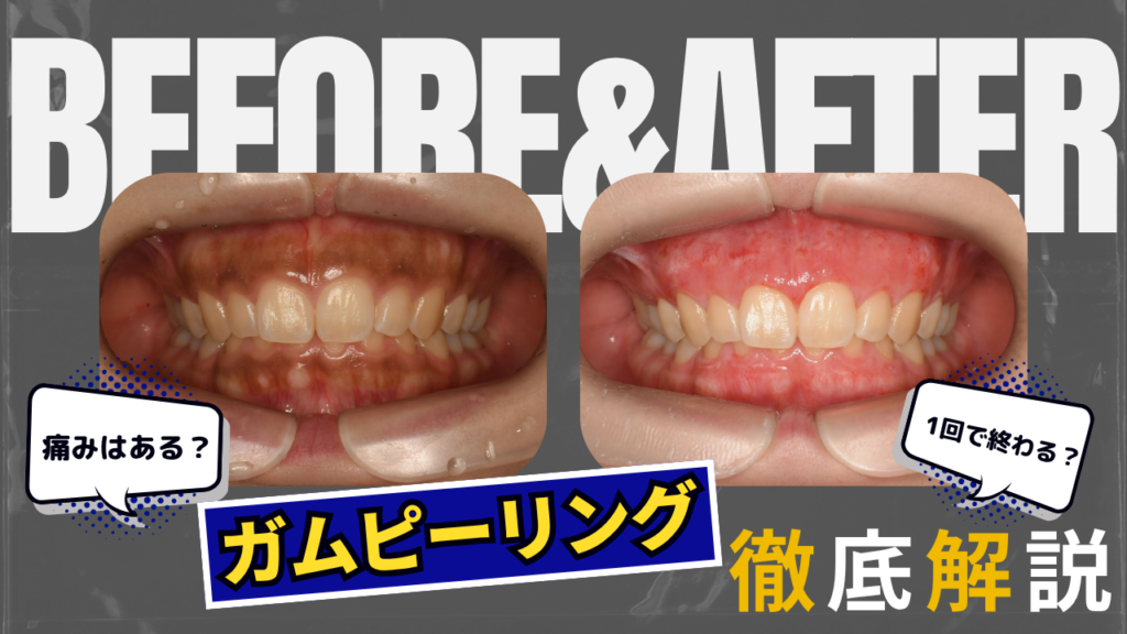 【ガムピーリング完全解説】 歯グキが黒いのを治す方法！痛い？回数は？費用は？動画解説も！