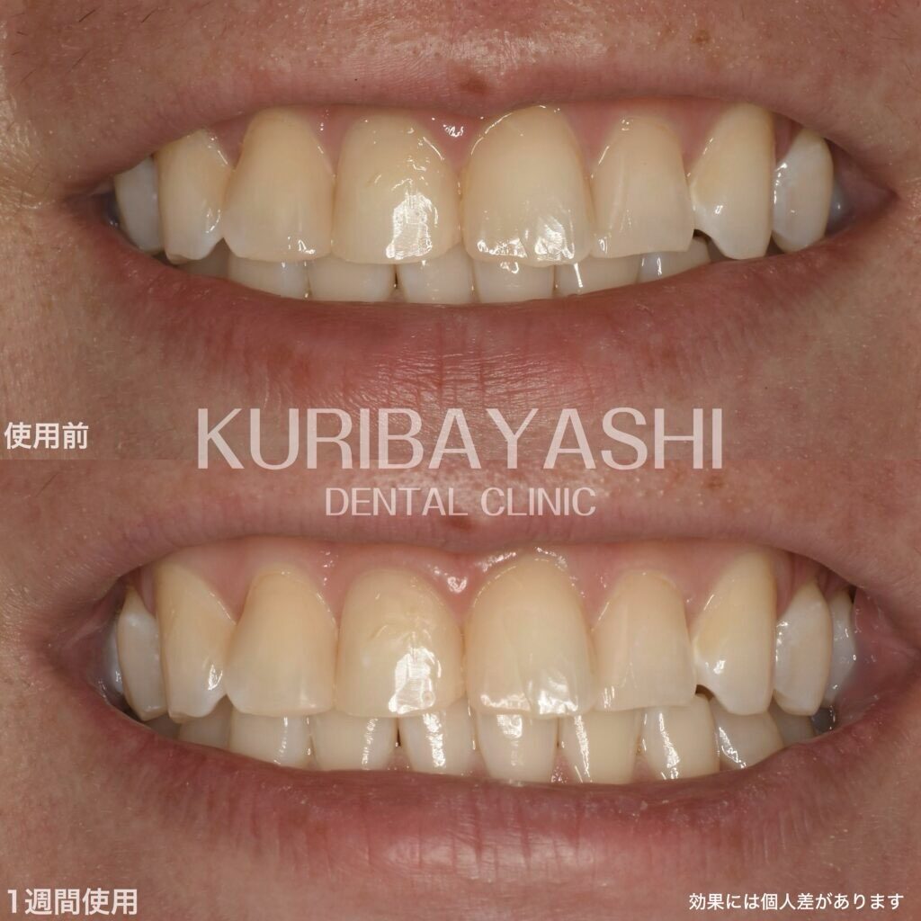【ホワイトニング完全版】ホワイトニングの効果・種類・値段・持続期間、ホワイトニング歯磨き粉の効果についてまるっと解説